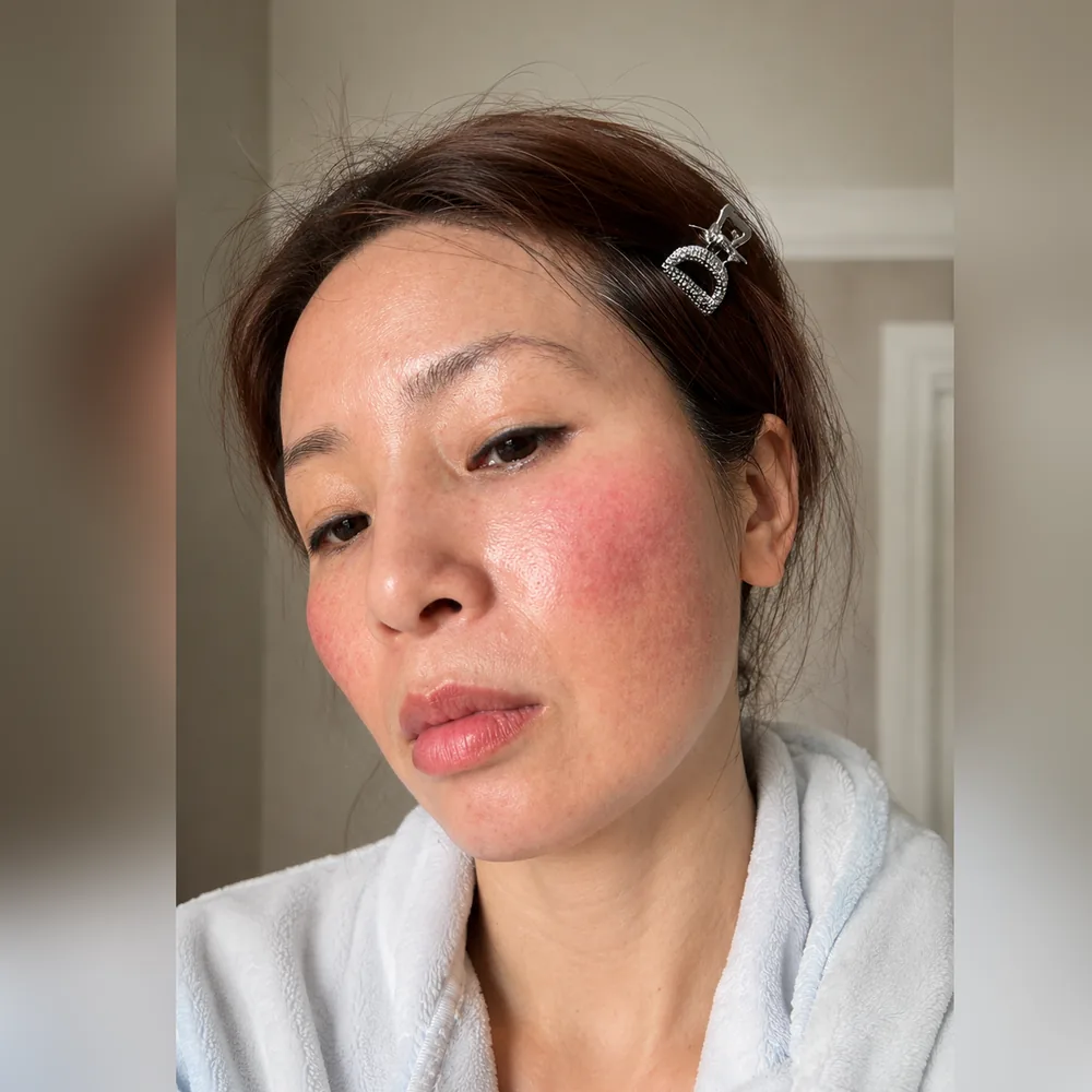 Client's cheek before and after intensive melasma treatment